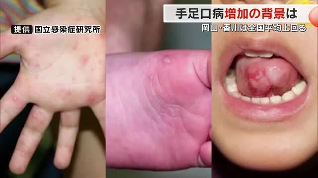 治っても再び感染…「手足口病」が全国的に流行　岡山県は過去１０年で最多　香川県では警報発令中